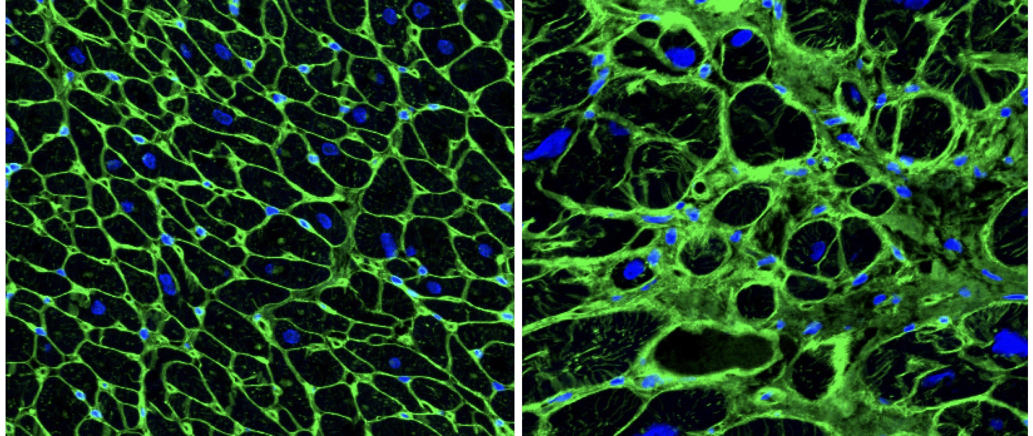 Single Cell Rna Sequencing Uncovers New Mechanisms Of Heart Disease